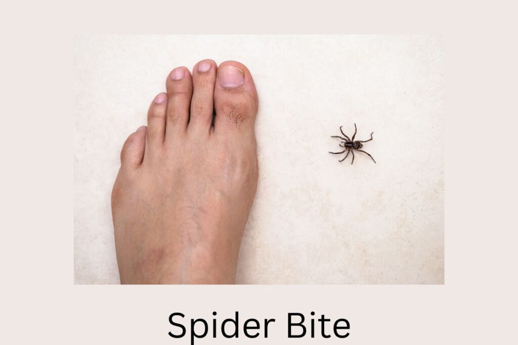 Spider Bite